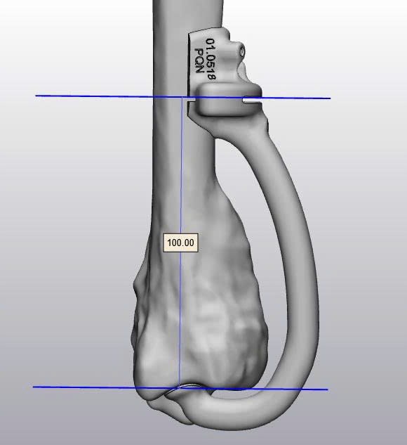 Patient-specific polymer instrument