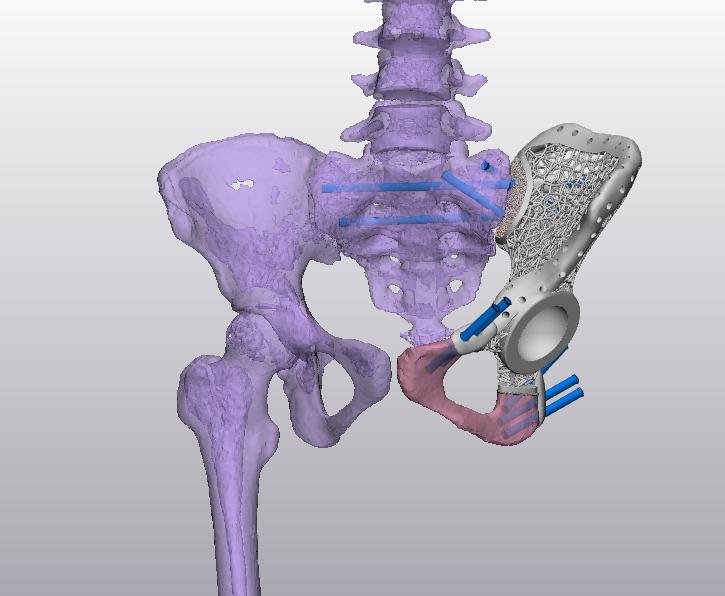 Titanium implant